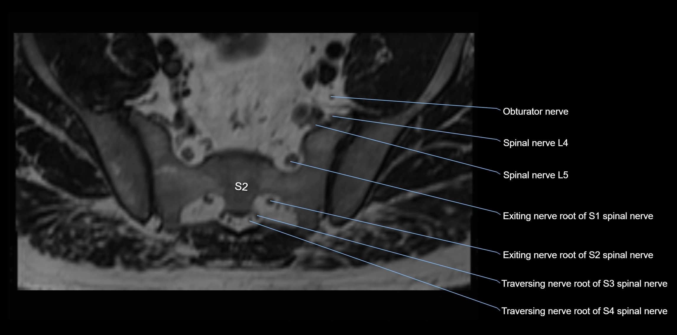 MR lumbosacral plexus axial cross sectional anatomy 3T  radiology  image-img-1008001-00083.webp